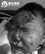 浙江19月大幼儿被恶犬咬至毁容 脸部缝上百针